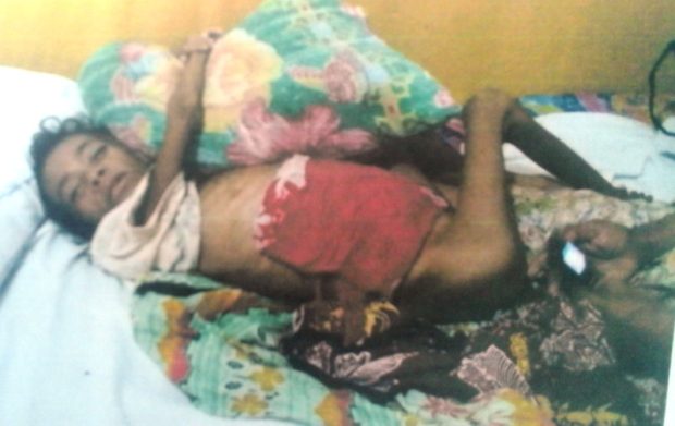Bocah Penderita Gizi Buruk Meninggal