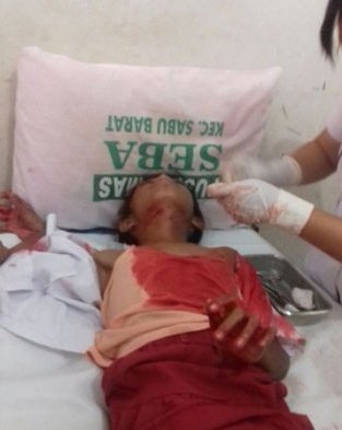 Pria Tak Dikenal Serang Siswa SD di Sabu Raijua dengan Senjata Tajam